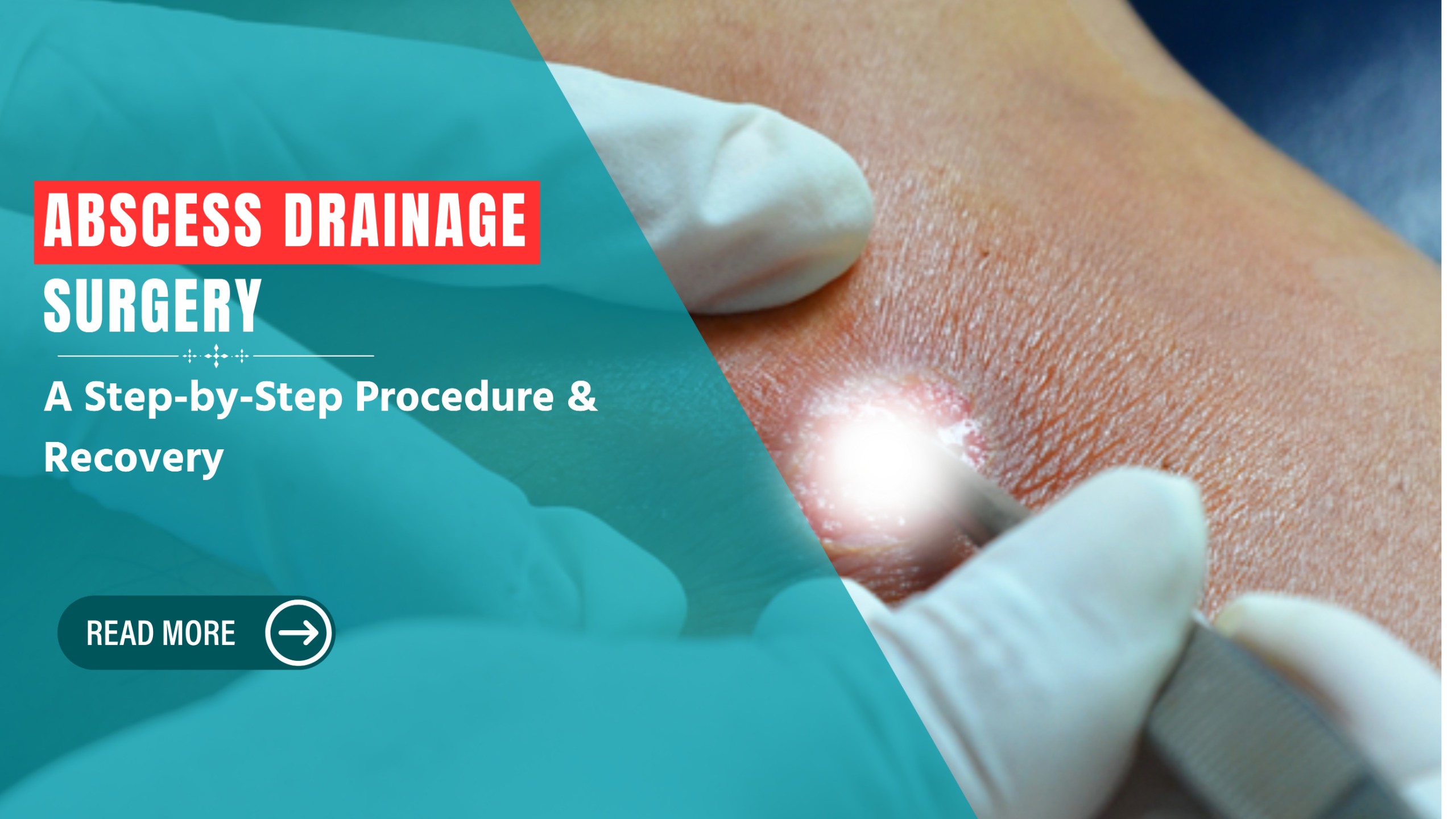 Abscess Drainage Surgery: A Step-by-Step Procedure & Recovery