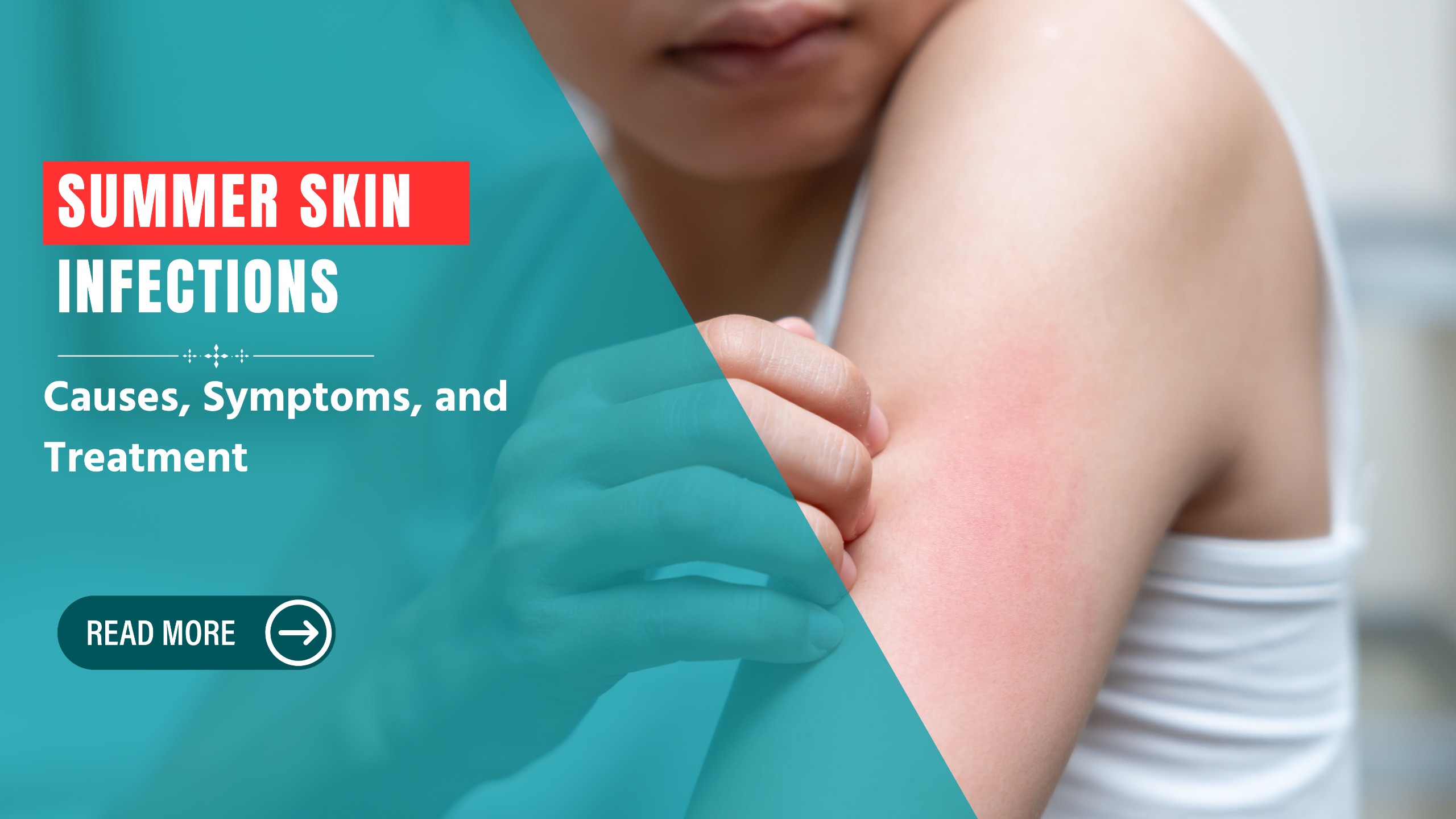 Summer Skin Infections: Causes, Symptoms, and Treatment